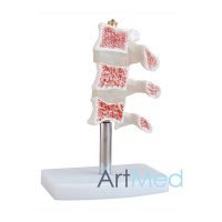 Coluna Osteoporose ART-134 | ArtMed